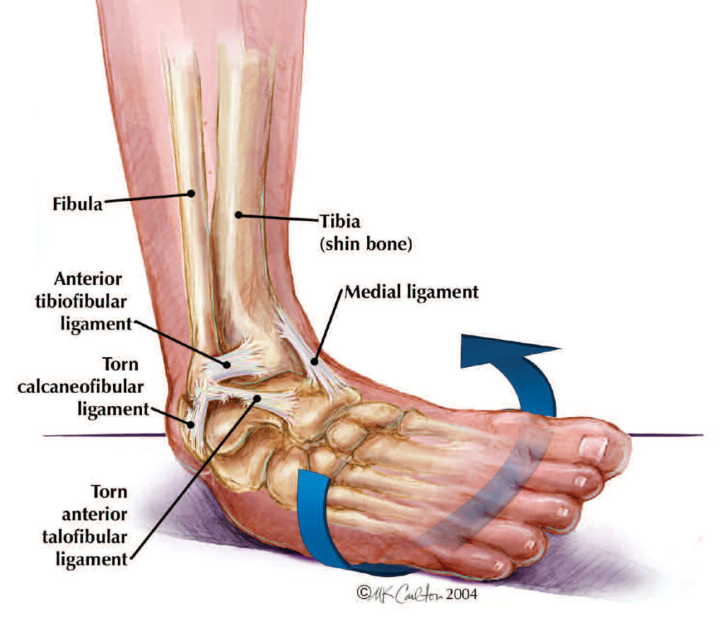 https://www.naplespodiatrist.com/wp-content/uploads/2021/09/ankle-sprains-1024x874.jpg