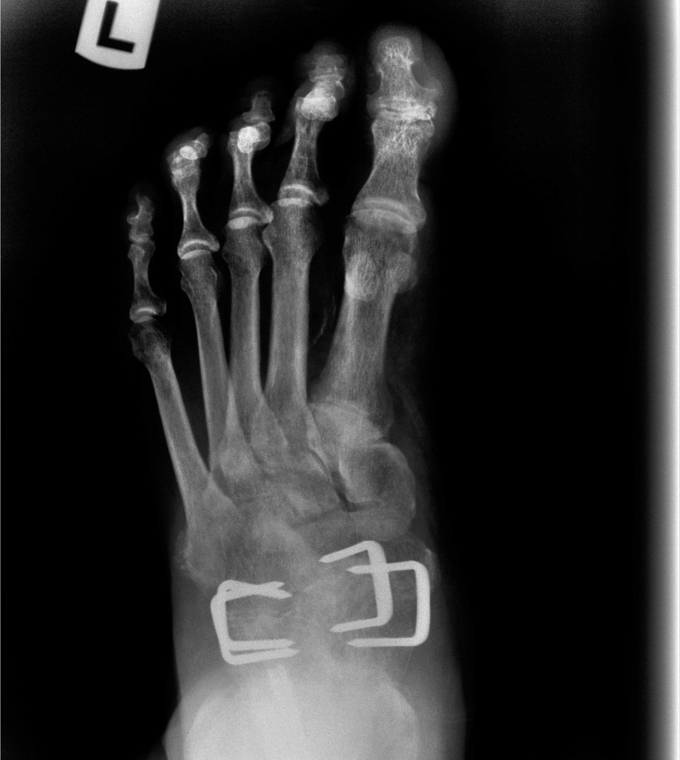 Postoperative AP X-ray showing staple fixation of the talonavicular joint