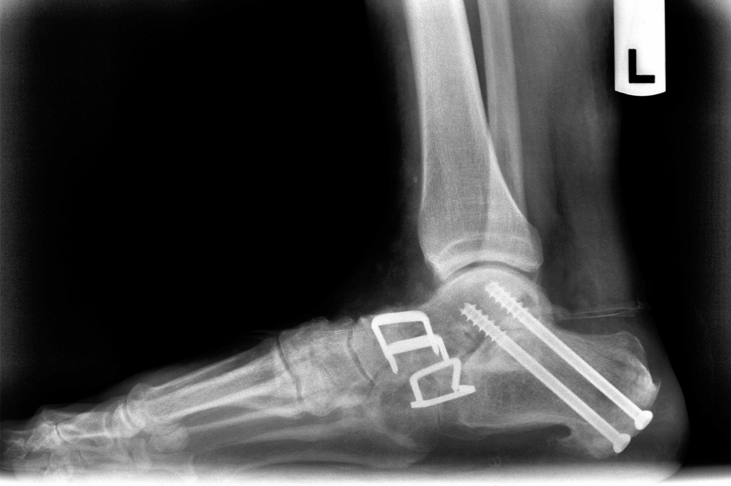 Postoperative lateral X-ray showing hardware fixation after triple arthrodesis with subtalar dowel fusion