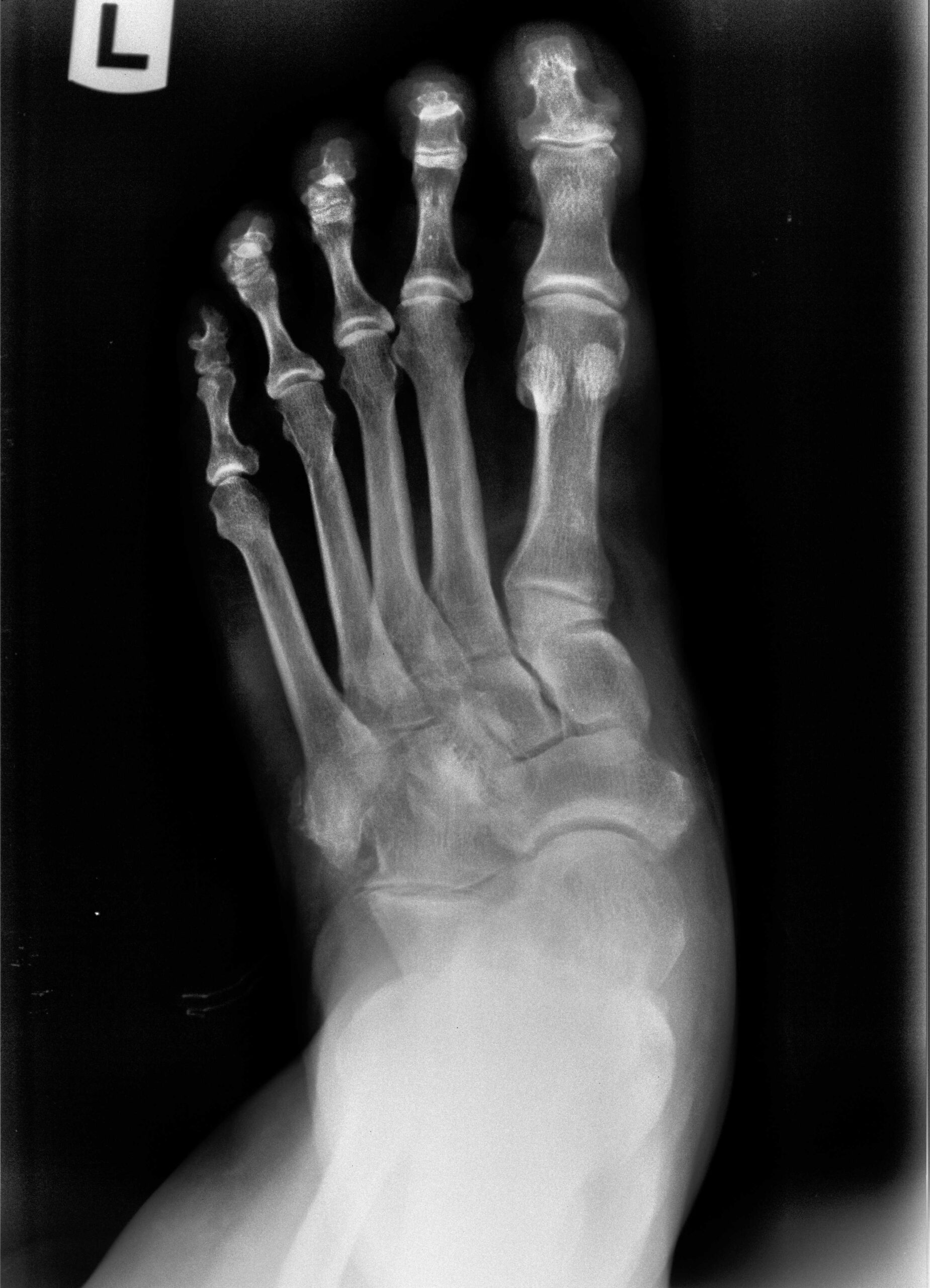 Preoperative AP X-ray showing talonavicular joint subluxation and forefoot abduction