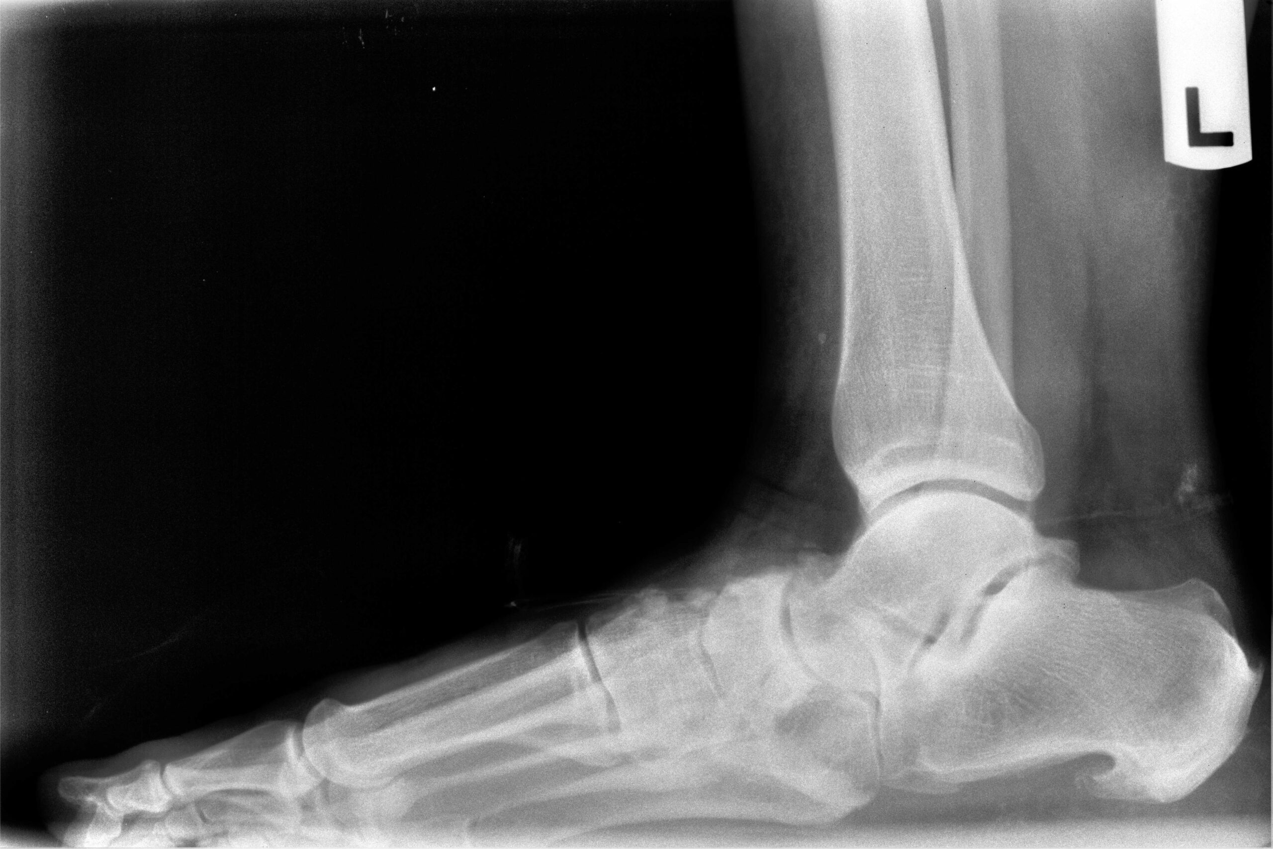 Preoperative lateral X-ray of collapsed talus with increased talar declination angle in adult acquired flatfoot deformity