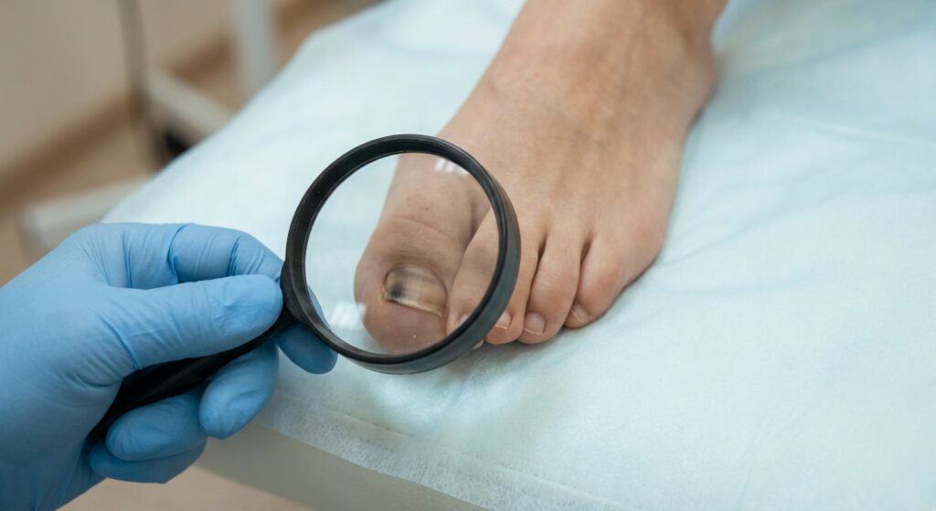 Toenail melanoma: how to spot subungual melanoma early