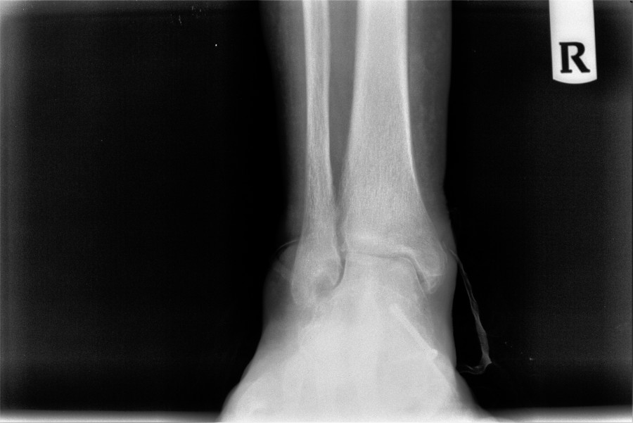 Pre-operative X-ray showing end-stage right ankle degenerative joint disease with joint space narrowing