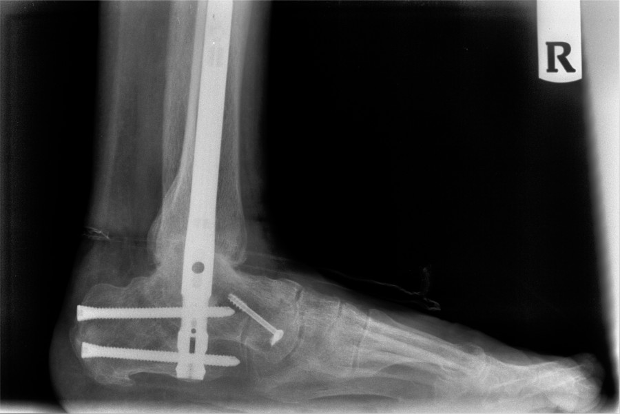 Post-operative lateral X-ray of right ankle fusion with intramedullary rod and screw fixation