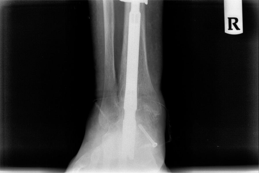 Post-operative AP X-ray of right ankle fusion showing hardware alignment